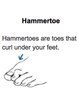 Hammertoe